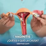 que es la vaginitis y sus causas wermar pharma